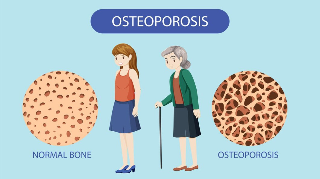 Dinkes Inhil Ajak Masyarakat Waspadai Osteoporosis